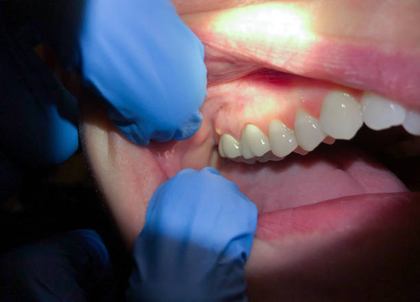 Best Knocked-Out Tooth (Avulsed Tooth) Treatment in Teutopolis, IL
